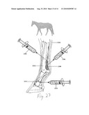 ENHANCED MEDICAL IMPLANT diagram and image