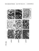 Grading, Staging and prognosing Cancer using Osteopontin-C diagram and image