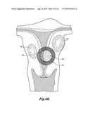 METHOD AND APPARATUS FOR TREATING TISSUES WITH HIFU diagram and image