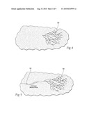 SYSTEMS AND METHODS FOR TREATING SUPERFICIAL VENOUS MALFORMATIONS LIKE SPIDER VEINS diagram and image