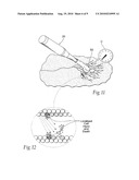 SYSTEMS AND METHODS FOR TREATING SUPERFICIAL VENOUS MALFORMATIONS LIKE SPIDER VEINS diagram and image