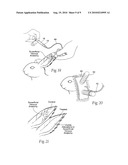 SYSTEMS AND METHODS FOR TREATING SUPERFICIAL VENOUS MALFORMATIONS LIKE SPIDER VEINS diagram and image