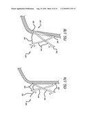 Electrical Conduction Block Implant Device diagram and image