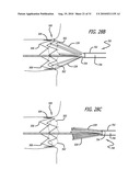 Electrical Conduction Block Implant Device diagram and image