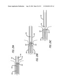 Electrical Conduction Block Implant Device diagram and image