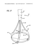 Electrical Conduction Block Implant Device diagram and image