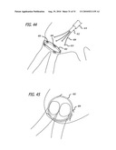 Electrical Conduction Block Implant Device diagram and image