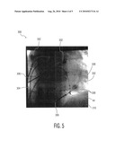 SYSTEM AND METHOD FOR VISUALIZING HEART MORPHOLOGY DURING ELECTROPHYSIOLOGY MAPPING AND TREATMENT diagram and image