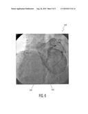 SYSTEM AND METHOD FOR VISUALIZING HEART MORPHOLOGY DURING ELECTROPHYSIOLOGY MAPPING AND TREATMENT diagram and image