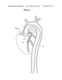 INTRAVASCULAR FOREIGN MATTER SUCTION ASSEMBLY diagram and image