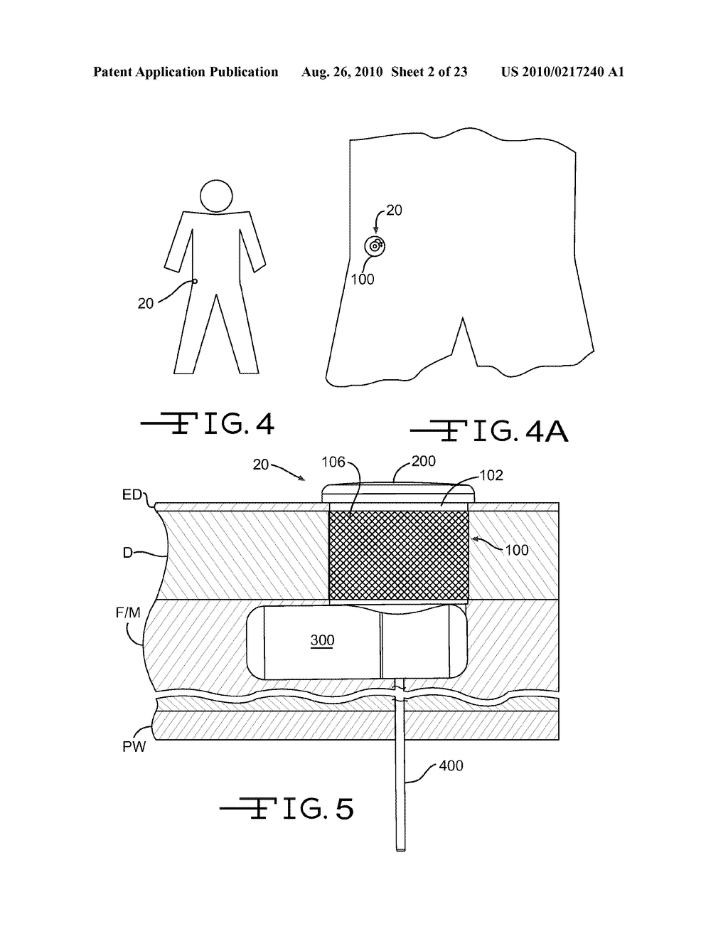 PARTIALLY IMPLANTABLE MEDICAL DEVICES WITH CARTRIDGE MOVEMENT SENSOR AND ASSOCIATED METHODS - diagram, schematic, and image 03