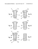 IMPLANT, IMPLANTATION TOOL, KIT AND METHOD diagram and image