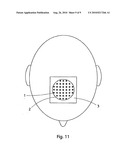 IMPLANT, IMPLANTATION TOOL, KIT AND METHOD diagram and image