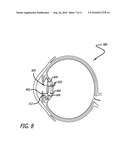 REAL-TIME SURGICAL REFERENCE INDICIUM APPARATUS AND METHODS FOR INTRAOCULAR LENS IMPLANTATION diagram and image