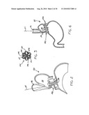 Transesophageal gastric reduction method and device for practicing same diagram and image