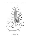 Transesophageal gastric reduction method and device for practicing same diagram and image