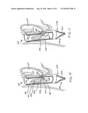 Transesophageal gastric reduction method and device for practicing same diagram and image