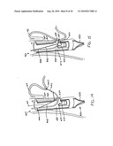 Transesophageal gastric reduction method and device for practicing same diagram and image