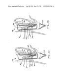 Transesophageal gastric reduction method and device for practicing same diagram and image