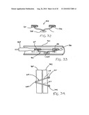 Transesophageal gastric reduction method and device for practicing same diagram and image