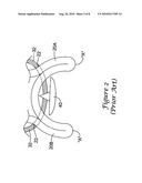 PLUG FOR ARTERIOTOMY CLOSURE AND METHOD OF USE diagram and image