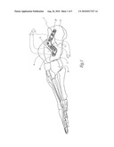 PLATE AND SYSTEM FOR LATERAL TREATMENT OF A FRACTURE OF THE CALCANEUS diagram and image