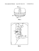 Computerized Planning Tool For Spine Surgery and Method and Device for Creating a Customized Guide for Implantations diagram and image