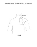 NEUROSTIMULATION FOR THE TREATMENT OF PULMONARY DISORDERS diagram and image