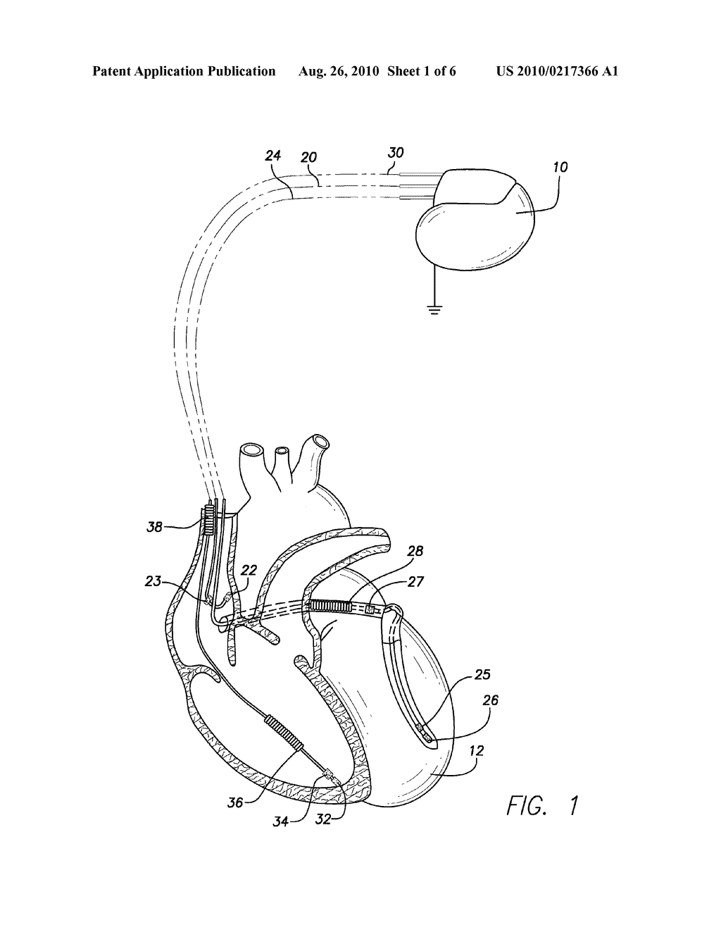 Implantable Medical Lead Circuitry and Methods for Reducing Heating and/or Induced Current - diagram, schematic, and image 02