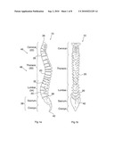 MODULATING BONE GROWTH IN TREATING SCOLIOSIS diagram and image