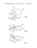 MODULATING BONE GROWTH IN TREATING SCOLIOSIS diagram and image