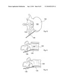 MODULATING BONE GROWTH IN TREATING SCOLIOSIS diagram and image