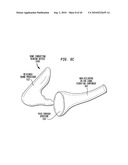 HEARING DEVICE HAVING A NON-OCCLUDING IN THE CANAL VIBRATING COMPONENT diagram and image