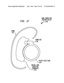 HEARING DEVICE HAVING A NON-OCCLUDING IN THE CANAL VIBRATING COMPONENT diagram and image