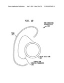 HEARING DEVICE HAVING A NON-OCCLUDING IN THE CANAL VIBRATING COMPONENT diagram and image