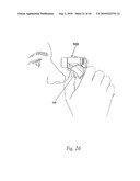 OPHTHALMIC FLUID DELIVERY SYSTEM diagram and image