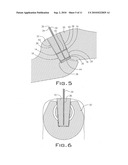 SPINAL PLUG FOR A MINIMALLY INVASIVE JOINT FUSION SYSTEM diagram and image