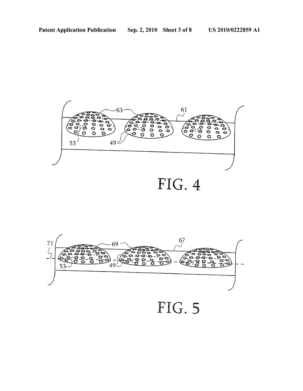 DUAL-PURPOSE LASSO CATHETER WITH IRRIGATION USING CIRCUMFERENTIALLY ARRANGED RING BUMP ELECTRODES - diagram, schematic, and image 04