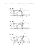 AIRWAY-OPENING DEVICE diagram and image