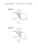 AIRWAY-OPENING DEVICE diagram and image