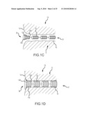 Inflatable device for enteric fistula treatment diagram and image