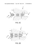 Inflatable device for enteric fistula treatment diagram and image