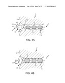 Inflatable device for enteric fistula treatment diagram and image