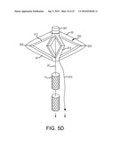 Inflatable device for enteric fistula treatment diagram and image