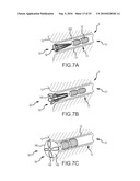 Inflatable device for enteric fistula treatment diagram and image