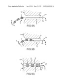 Inflatable device for enteric fistula treatment diagram and image