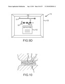 Inflatable device for enteric fistula treatment diagram and image