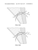 Inflatable device for enteric fistula treatment diagram and image