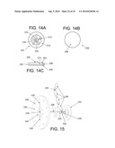 Inflatable device for enteric fistula treatment diagram and image