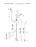 Inflatable device for enteric fistula treatment diagram and image